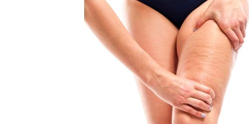 Anticelulitis/Antiflacidez