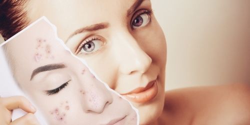 Tratamiento antiacné