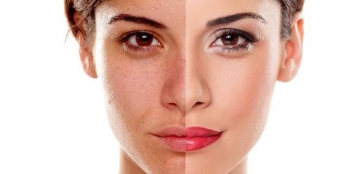 Despigmentación de Manchas