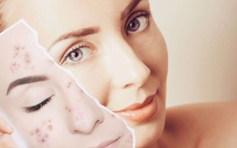 Tratamiento antiacne