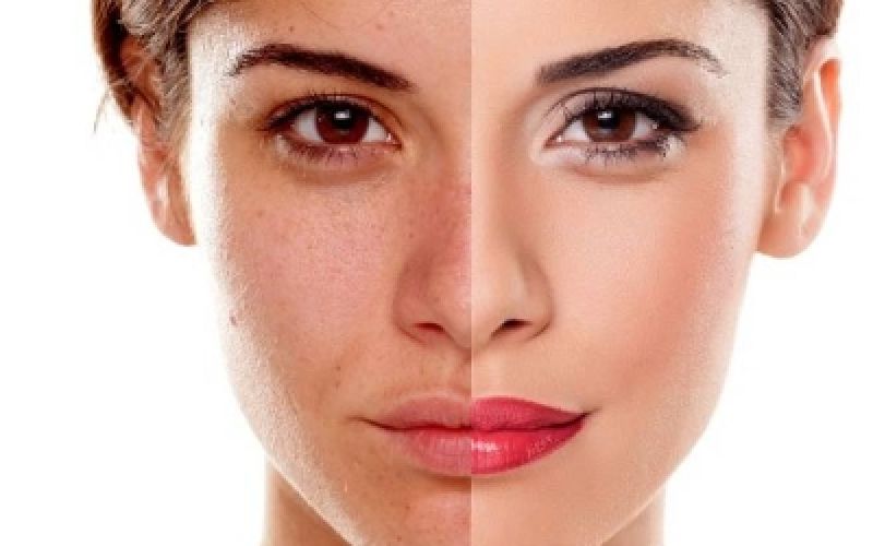 Despigmentación de manchas